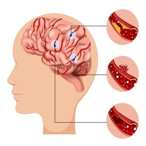 Read more about the article Cranial Stabilization System Market Analysis Highlights Key Players and Competitive Landscape